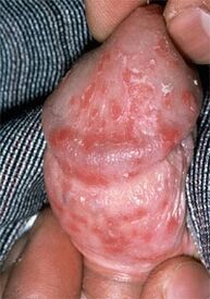Descarga do pene debido á candidiasis